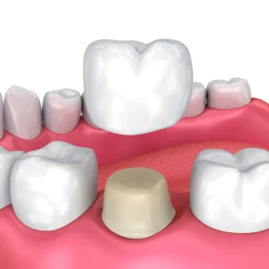 Dental Crowns
