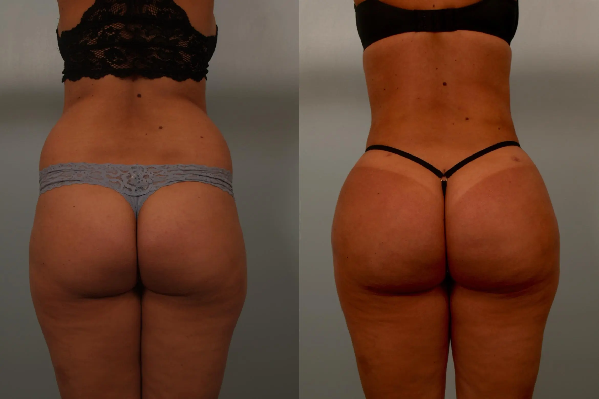 buttock-augmentation-119-view-1-detail