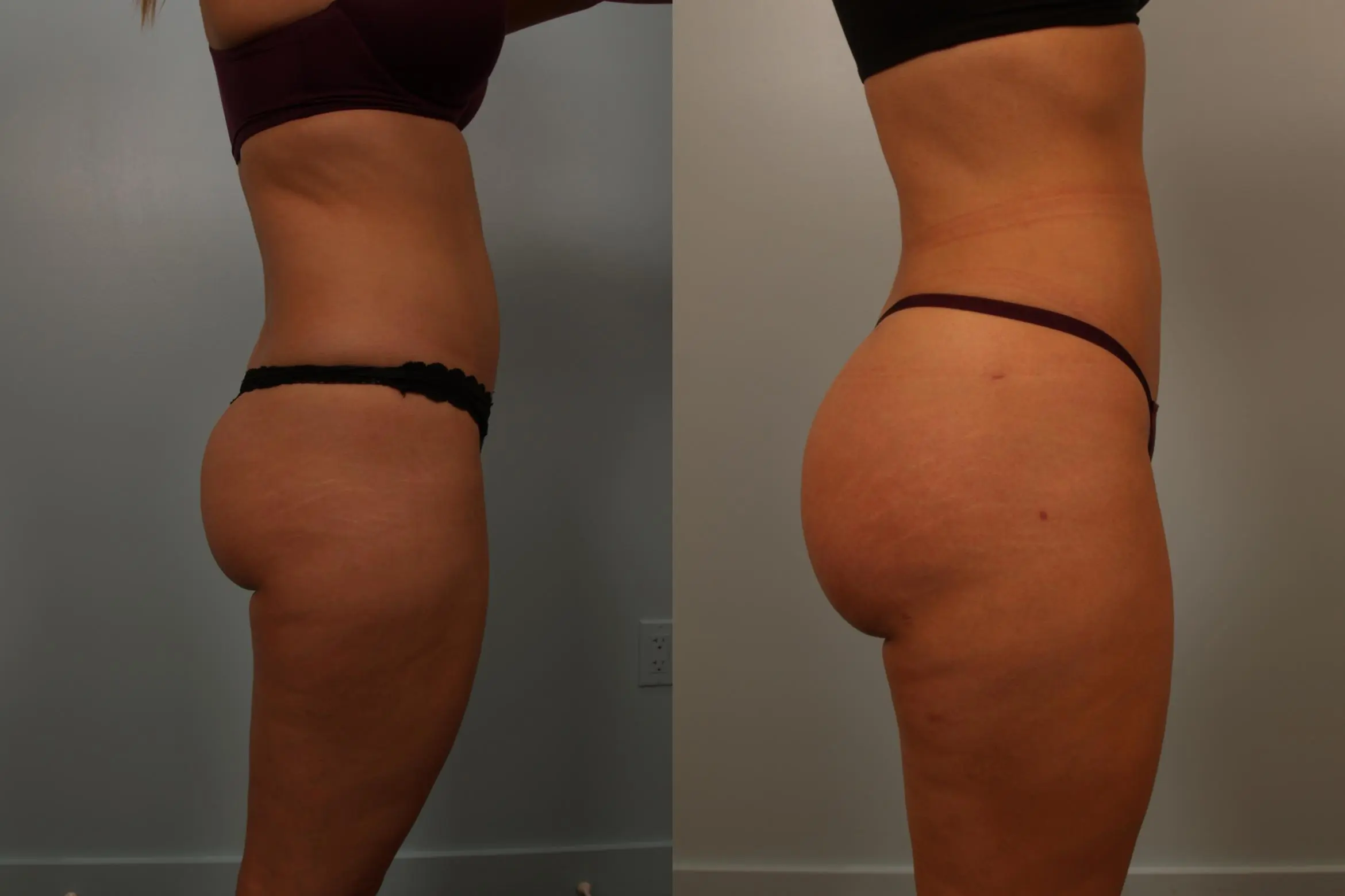 buttock-augmentation-131-view-4-detail