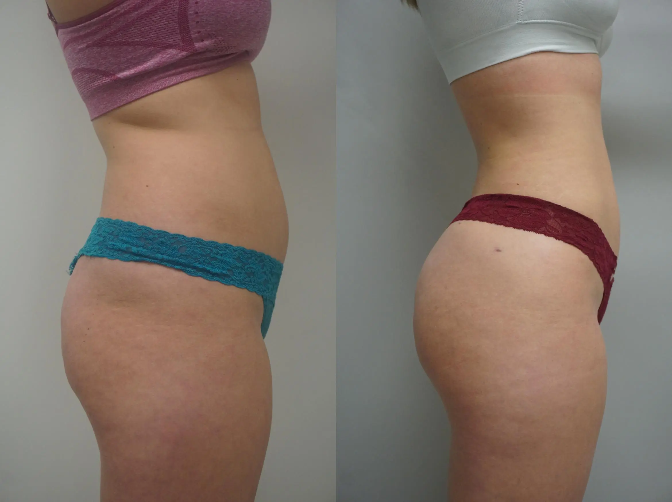 buttock-augmentation-262-view-2-detail