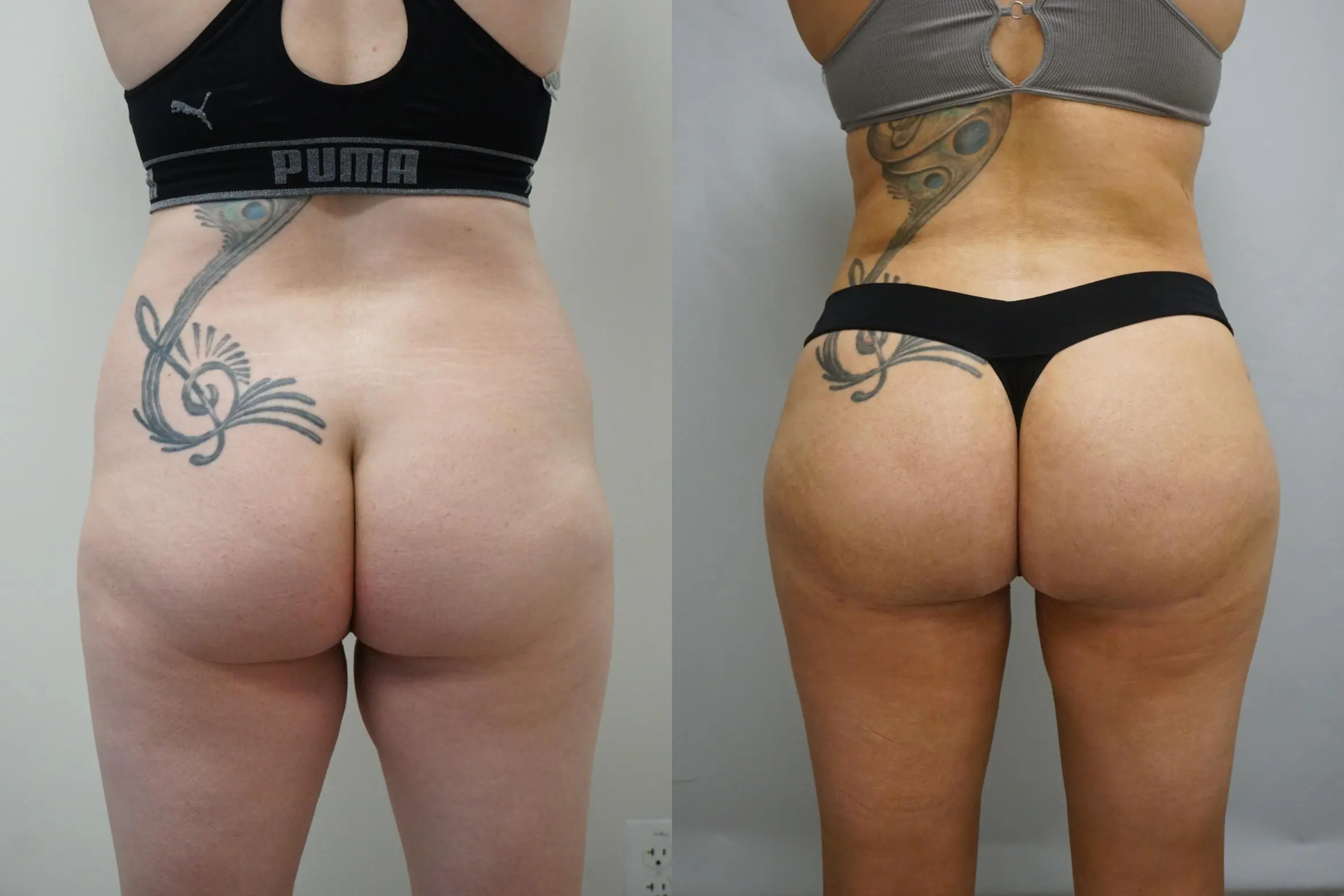 buttock-augmentation-294-back-detail