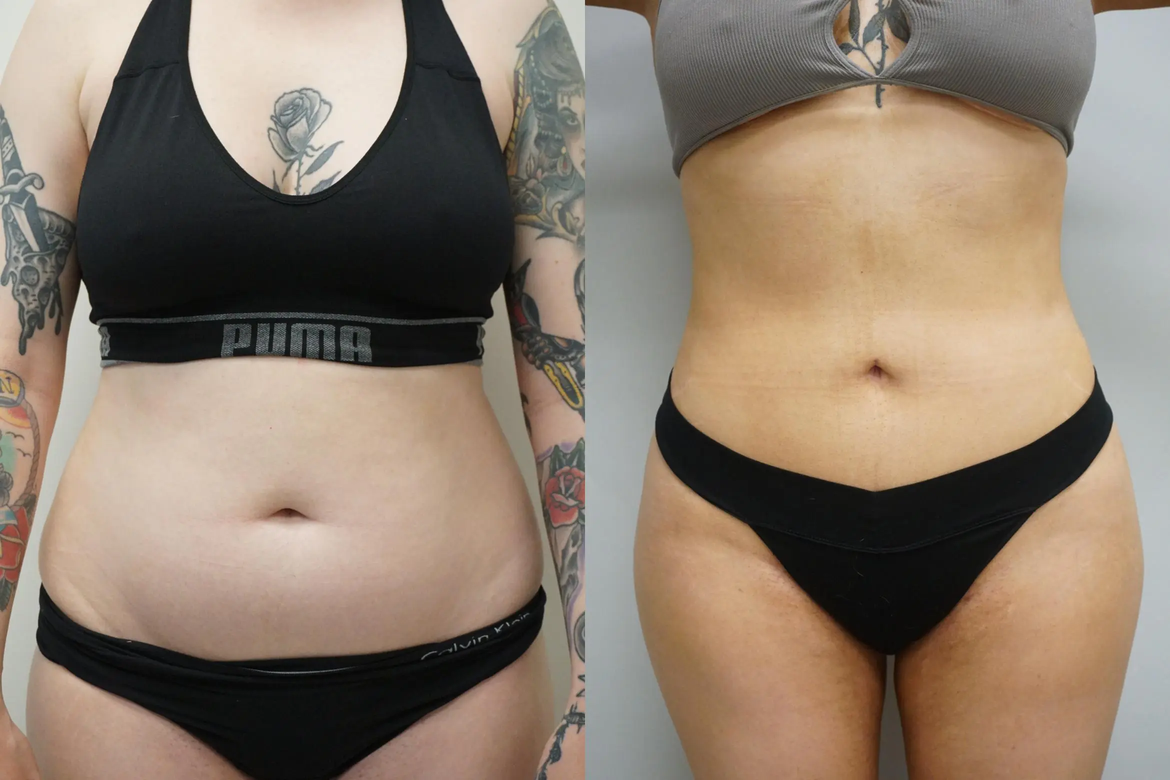 buttock-augmentation-294-front-detail