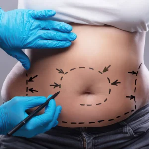 Liposuction