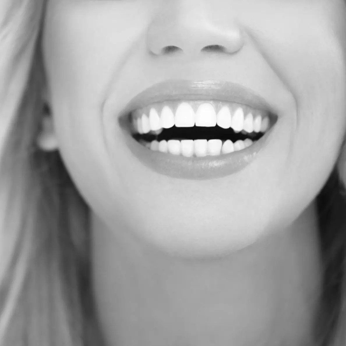 Dental Veneers (Hollywood Smile)